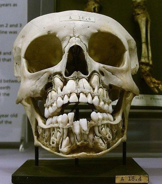此颅骨为换牙期儿童的头骨.可同时看到乳牙和待萌出的恒牙.