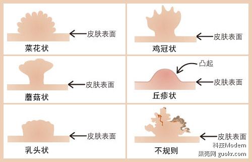 尖锐湿疣（生殖器疣）出于台湾某医院网站文章 | 日志 | 果壳网 科技有意思