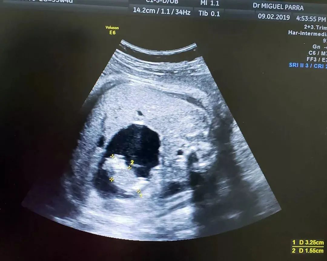“生下来活下去，投胎是来报恩的”，医生解释出很多人保投胎原因_孩子