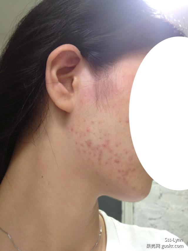 腮边痘 www.guokr.com
