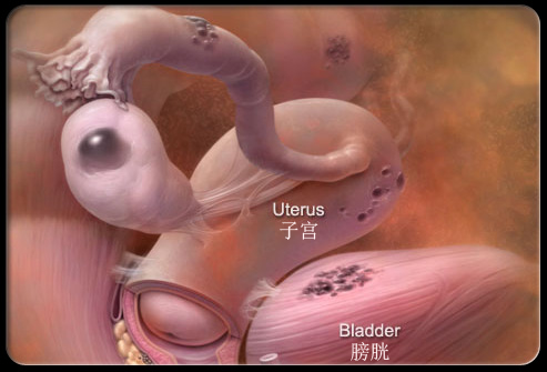 暗色斑点部为异位生长的子宫内膜。
