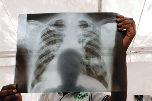 乌干达里拉市一名结核病人的胸部X光片。每年新增的结核病人中有约80%集中出现在22个国家，乌干达就是其中之一。图片：J. MATTHEWS/PANOS