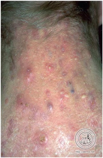 该图显示典型的痤疮皮损：白、黑头粉刺，丘疹，脓疱，囊肿及瘢痕。图片来自DermIS