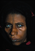 白内障患者的照片。图片来自：世界卫生组织网站。