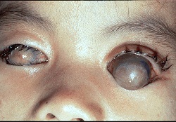 一起严重的维生素A缺乏导致的干眼症图/eyepathologist.com