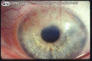 角膜周边血管翳。Copyright @ Online Journal of Ophthalmology