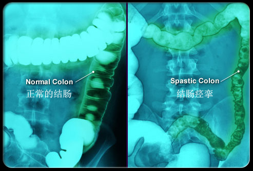 正常结肠（左）与痉挛的结肠（右）。