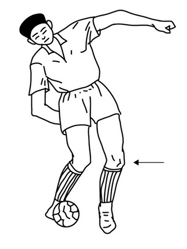 在足球运动中，右脚向左踢球用力过猛，造成身体过度左旋，左小腿内收内旋，就造成了左侧半月板损伤。