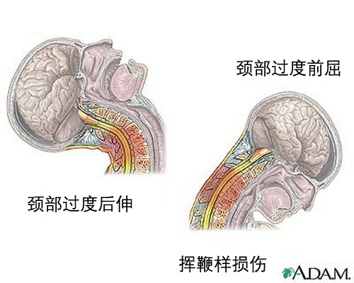 车祸现场的尸体,真的死于车祸吗?