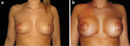 21岁女性轻度乳房不对称，左：隆胸术前；右：隆胸术后[3]